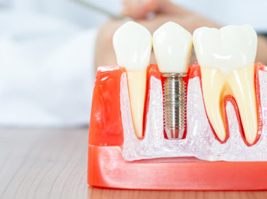 dental implants treatment in Bandra